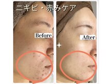 リラベル(Lira Belle)/口周りの赤み鎮静