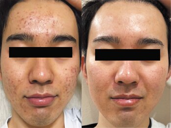 デジール/ニキビケアメンズ水光ピーリング