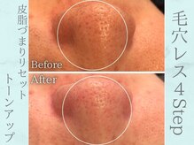 ネオファースト(NeoFirst)/つるんと毛穴レス肌が叶います★