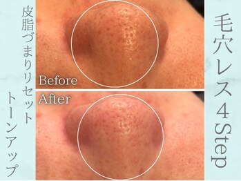 ネオファースト(NeoFirst)/つるんと毛穴レス肌が叶います★