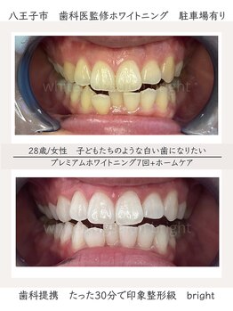ブライト 八王子(bright)/28歳女性/八王子ホワイトニング