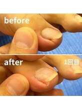 かがわ接骨院 高松伏石院/巻き爪でお悩みの方へ！