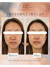 エクラヴィ(Eclatvie)/３０代★施術事例
