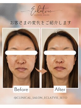 エクラヴィ(Eclatvie)/30代★施術事例