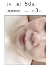 リベル 名古屋(Lebelle:)/ハーブピーリング　名古屋