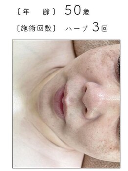 リベル 名古屋(Lebelle:)/ハーブピーリング 名古屋