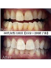ホワイト 福岡博多店(WHITE)/ホワイトニングビフォーアフター