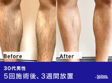アトリウム オム 恵比寿店(ATRIUM HOMME)/足脱毛ビフォアフター