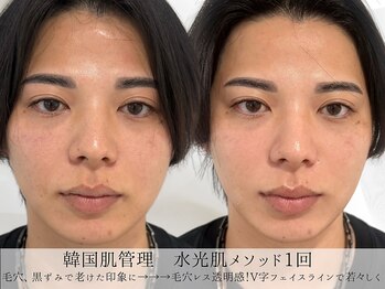 ミヨンラボ(miyon LABO)/韓国肌管理水光肌メソッド1回