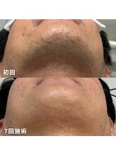 ビビ(BB)/30代後半のお客様のヒゲ脱毛
