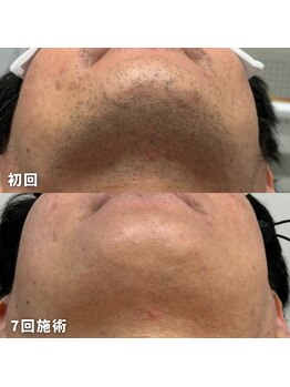 ビビ(BB)/30代後半のお客様のヒゲ脱毛