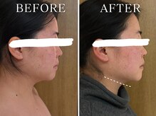 ヨサパーク ニコナ 三軒茶屋南口(YOSA PARK nicona)/1回でフェイスラインスッキリ！