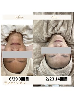 ケアビューティーソラ(care beauty SORA)/光フェイシャル