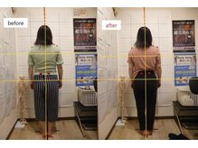 豊田まえやま接骨院/産後骨盤矯正　２０代女性
