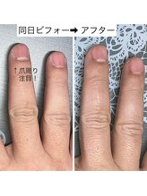 桃の木 吉祥寺店/爪周りの乾燥