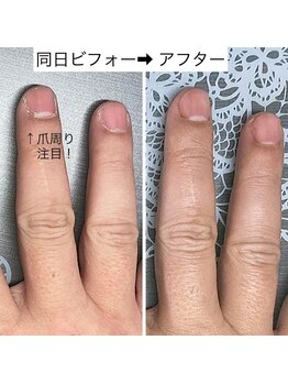 桃の木 吉祥寺店/爪周りの乾燥