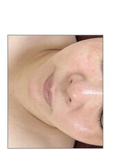 リベル 名古屋(Lebelle:)/ハーブピーリング　名古屋