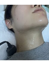 ミナミ/小顔リフトアップ