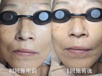 エレヌイ(ELENUI)/最新光フェイシャル★たるみ改善