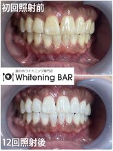 ホワイトニングバー アティ郡山店/12回コース終了ビフォーアフター