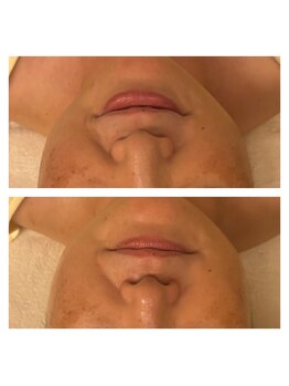 ぷるるりぶーる/エイジング小顔ハーブピーリング