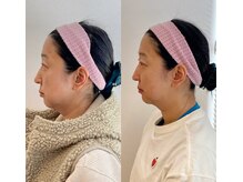 小顔22 ボルティ 赤坂支店(Bolty)/【悩み】50代：二重顎