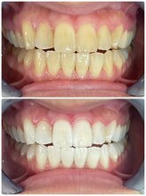 エクシア ホワイトニング 富山店/ビフォーアフター写真☆