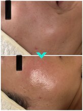 ミルキー(Milky)/若肌！マツヤニｘクレイパック