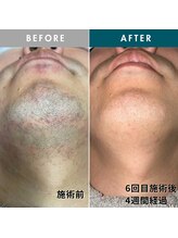 モモナ(Momona)/佐世保/脱毛/髭脱毛/全身脱毛