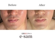 イーサム(e-sam)/髭脱毛