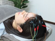 鍼灸院 整骨院ティップ 春日院/眼精疲労への鍼施術