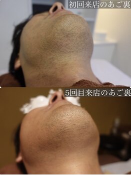 メンテ(MENTE)/濃い髭でお悩みの方にも