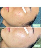 ちらちゅら/クリスティーナ【施術2回】経過