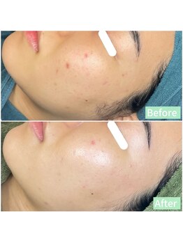 ちらちゅら/クリスティーナ【施術2回】経過