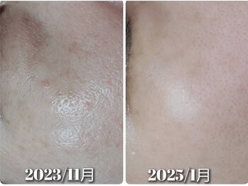 ブライトリー(Brightly)/シミ改善・毛穴ケア!