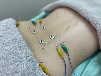 もみの木整骨院の写真/≪鍼灸施術45分￥7,700～!!≫デスクワークからくるつらい腰痛に。お仕事終わりでも◎痛みは早めに改善を♪
