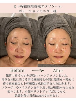 フワリ(fuwari)/ヒト幹細胞培養液ポレーション