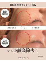 ラ リリー ステラ(La Lily stella)/シミ徹底改善！