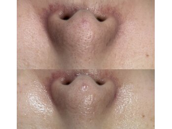 ココリール/毛穴の黒ずみ