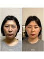 整音(totonone) 頭の張りによりおでこが下がり目を圧迫、おでこや目の矯正で改善