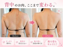 ヨサパーク アカーシャ(YOSA PARK AKASHA)/背中美人を目指しませんか？