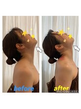 サクラプラス(SAKURA Plus)/カッピングドレナージュ