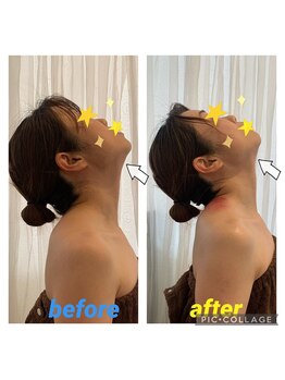 サクラプラス(SAKURA Plus)/カッピングドレナージュ