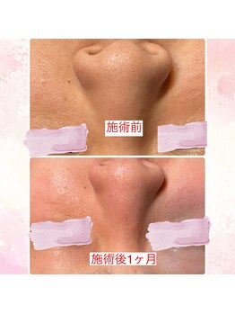 ノノ(nono)/いちご鼻も改善！