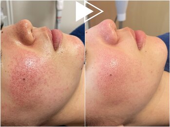 リシェス(Richesse)/赤ら顔改善ハーブ★初回¥11990