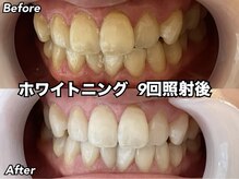 ヴィオール 名古屋栄店(VIOR)/ホワイトニング！1日3回照射＊