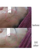 アップルミント/＜フェイシャル＞before・after