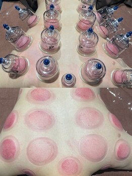 リレス(Riless)の写真/立ち仕事や座りっぱなしで足がパンパン&むくみが気になる…そんな方に!下半身引き締め+カッピング→¥12,600