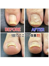 キラキラフット神領 ありが接骨院/巻き爪/フットケア