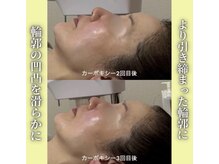 ハニエル(Haniel)/カーボキシー症例